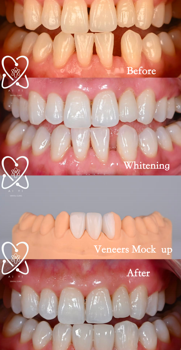 Veneer (With simulation Mock-up)