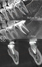 Root Canal Treatment