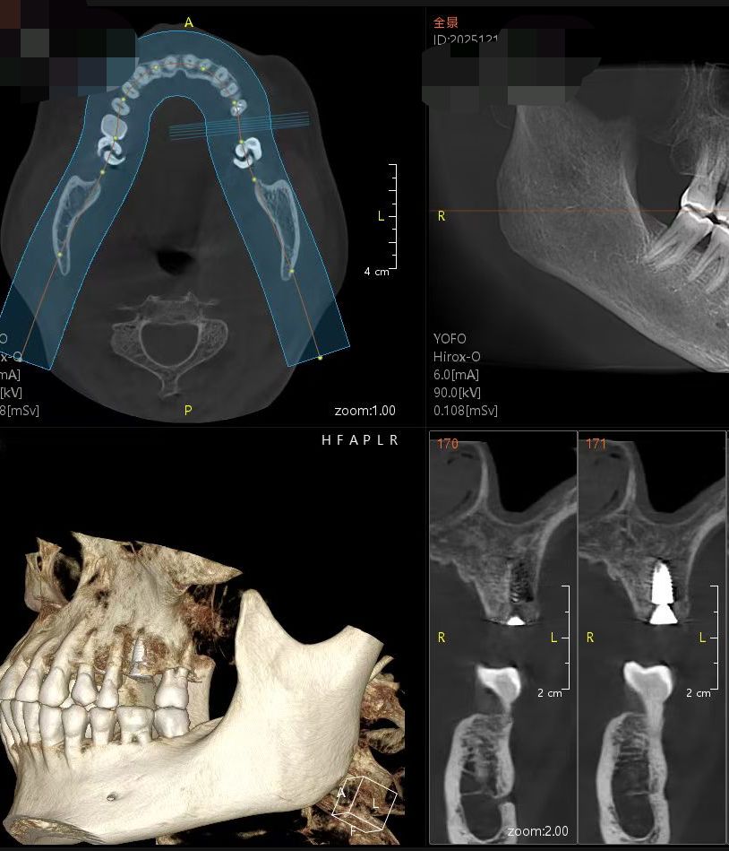 Digital Scan of restoring missing teeth with dental implants and ceramic crowns.